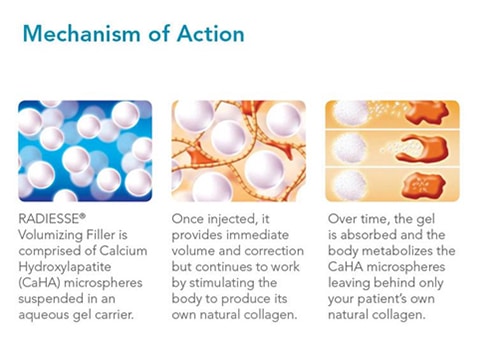 Illustration showing Radiesse® filler with CaHA microspheres stimulating collagen and gradually being absorbed by the body