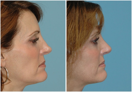 Side-by-side comparison showing improved nasal contour after revision rhinoplasty using cartilage reconstruction and Alloderm
