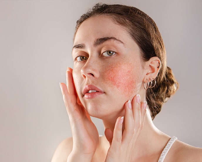 Woman touching red, inflamed skin on her cheek, showing visible symptoms of rosacea and skin sensitivity