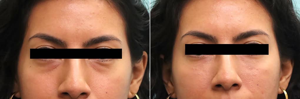 Before and after of female patient showing reduced under-eye bags and smoother mid-face contour from Voluma fillers