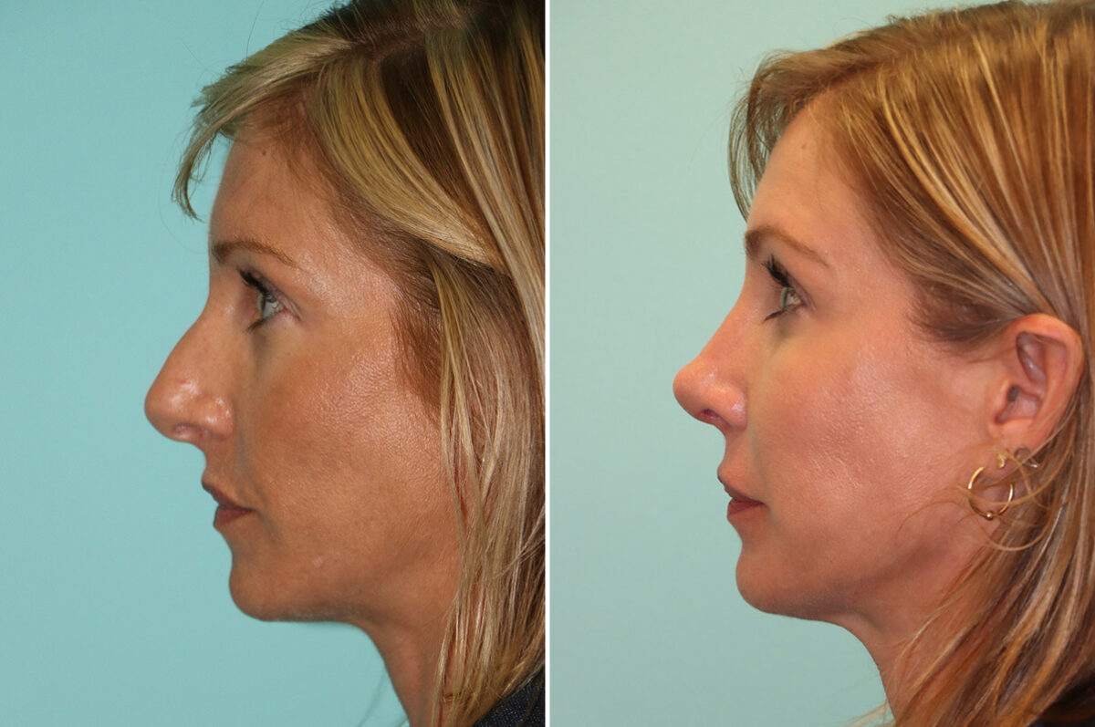 Before and after Morpheus8 by Dr. Shervin Naderi, Patient 44017