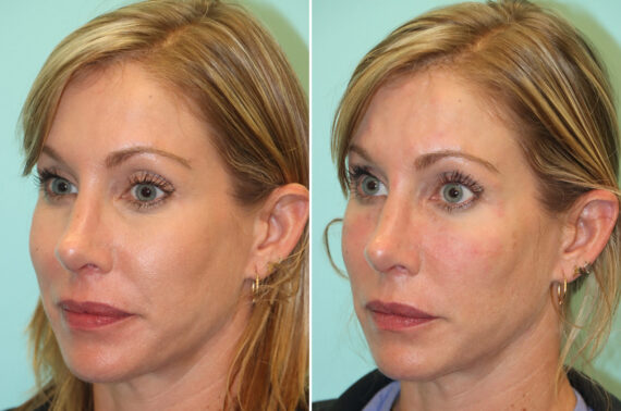 Before and after Cheeks / Midface Injections by Dr. Shervin Naderi, Patient 44027
