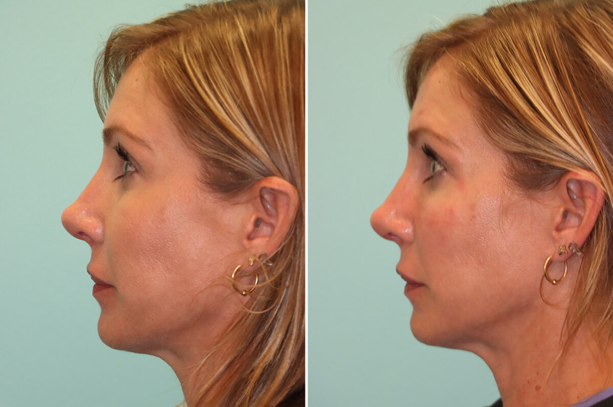 Before and after Cheeks / Midface Injections by Dr. Shervin Naderi, Patient 44027