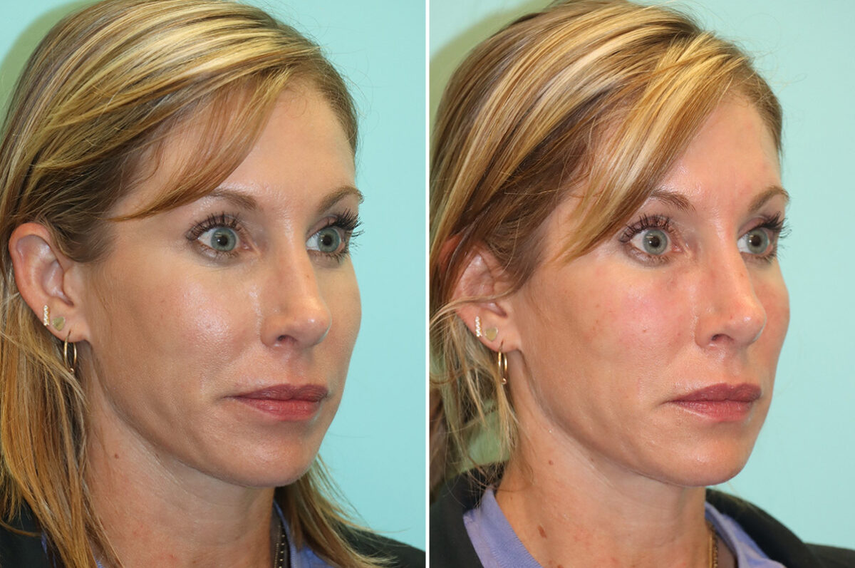Before and after Cheeks / Midface Injections by Dr. Shervin Naderi, Patient 44027