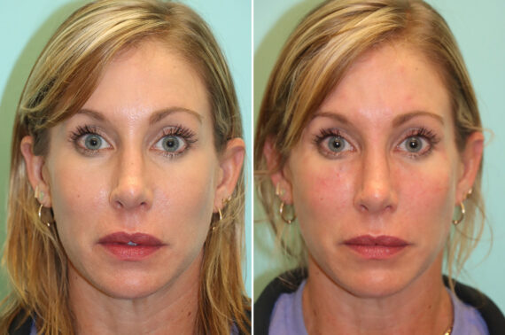 Before and after Cheeks / Midface Injections by Dr. Shervin Naderi, Patient 44027