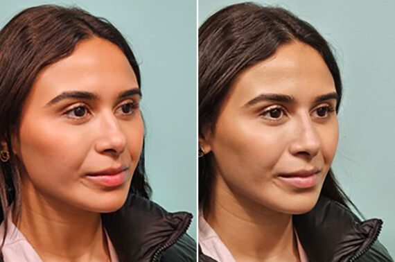 Before and after Non-Surgical Rhinoplasty by Dr. Shervin Naderi, Patient 44198
