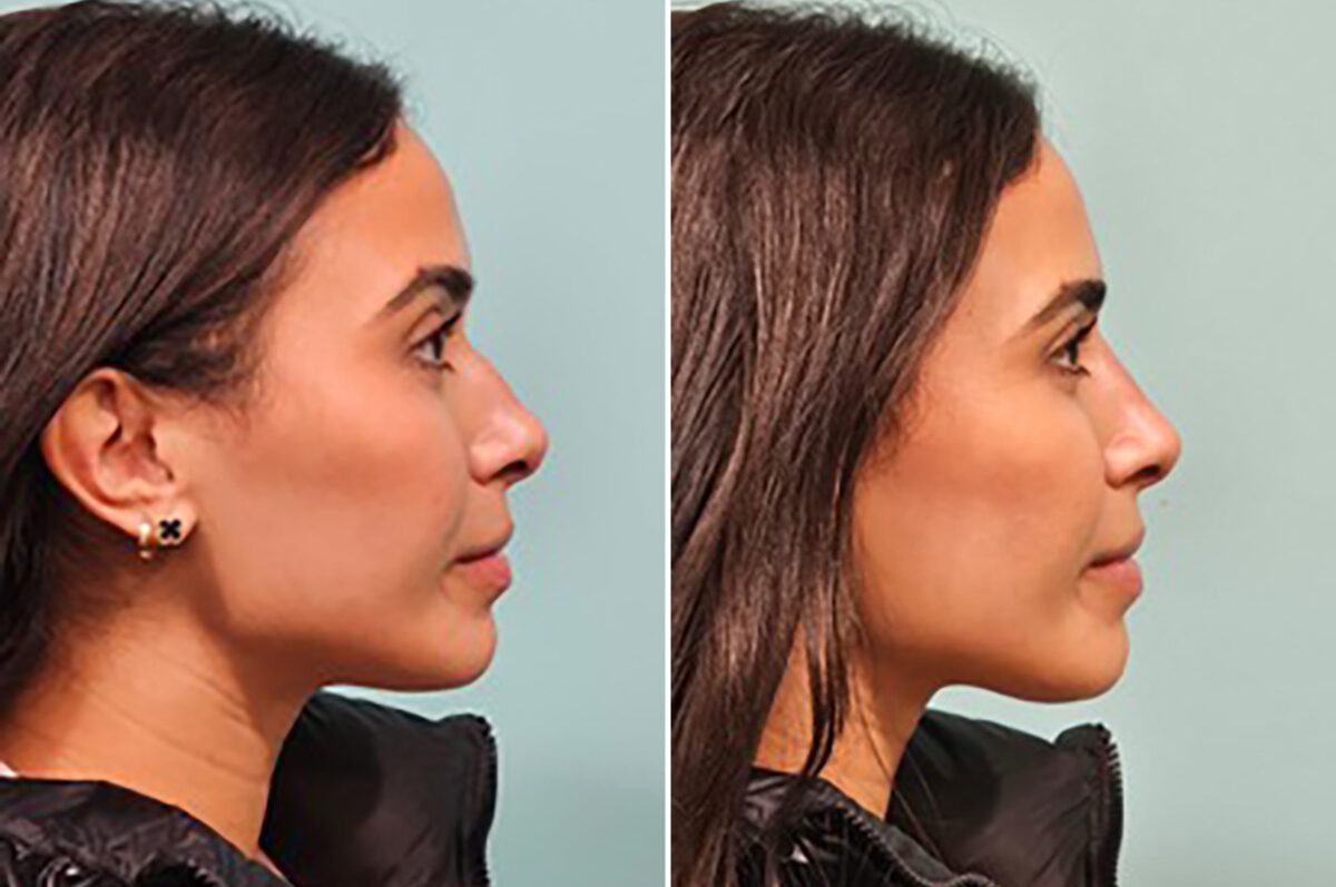 Before and after Non-Surgical Rhinoplasty by Dr. Shervin Naderi, Patient 44198