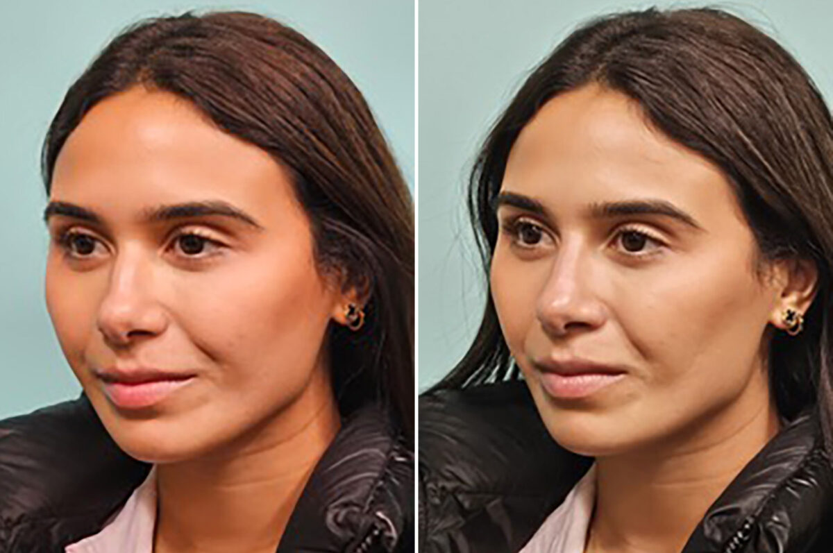 Before and after Non-Surgical Rhinoplasty by Dr. Shervin Naderi, Patient 44198