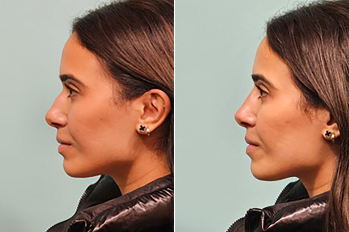 Before and after Non-Surgical Rhinoplasty by Dr. Shervin Naderi, Patient 44198