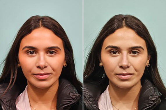 Before and after Non-Surgical Rhinoplasty by Dr. Shervin Naderi, Patient 44198