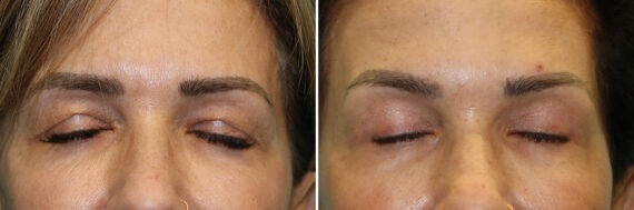 Before and after Blepharoplasty by Dr. Shervin Naderi, Patient 44366