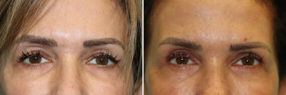 Before and after Blepharoplasty by Dr. Shervin Naderi, Patient 44366