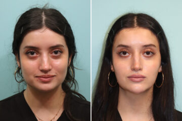Before and after Botox Injections by Dr. Shervin Naderi, Patient 44641