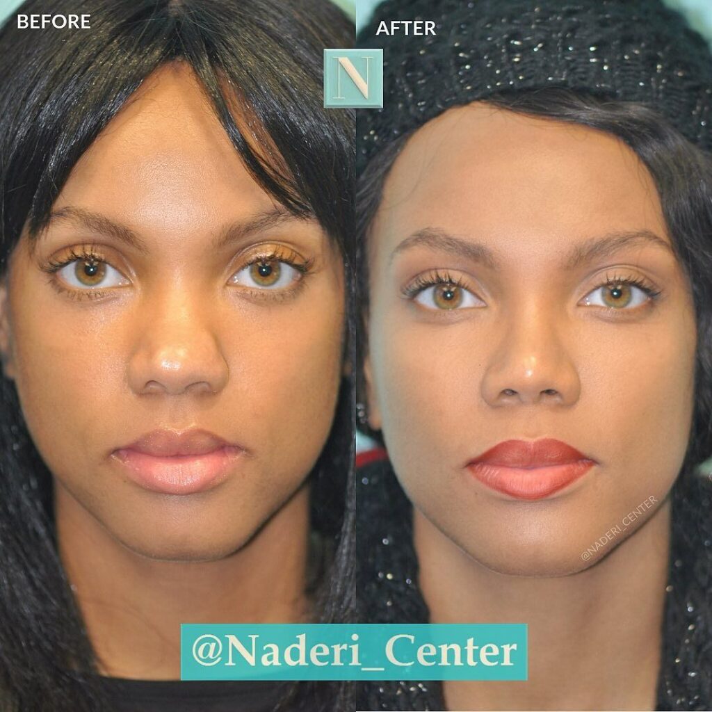 Before and after of African American woman showing defined nasal tip and narrowed nostrils with natural-looking results.