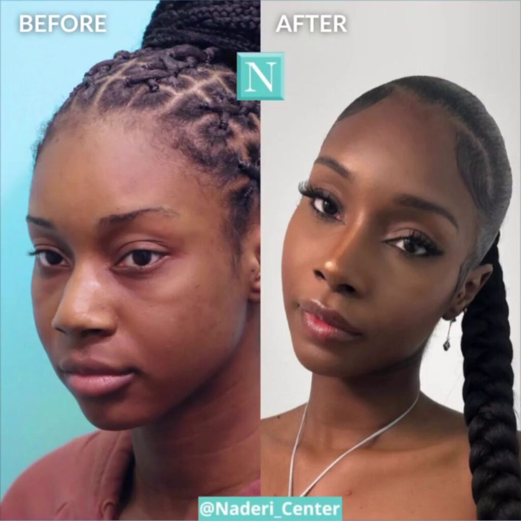Before and after of Black woman with refined nose, illustrating expert ethnic rhinoplasty by a certified specialist.