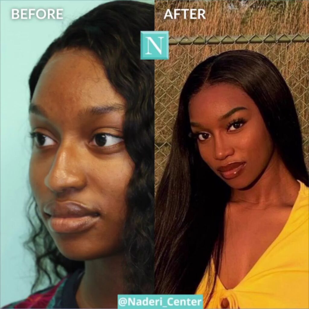 Side-by-side before and after rhinoplasty of a Black woman, showing natural-looking, ethnicity-respecting nose refinement.