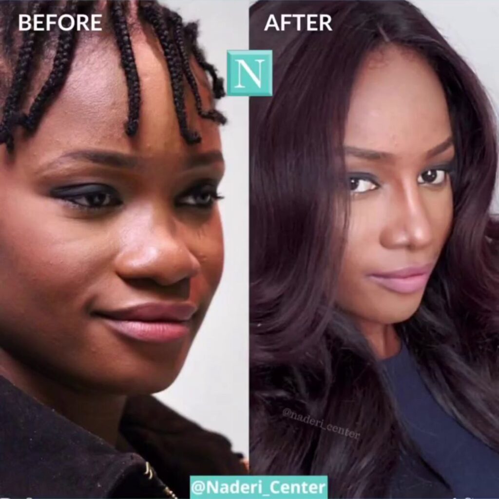 Before and after of African woman showing improved nasal definition, highlighting thick-skin rhinoplasty and healing process.