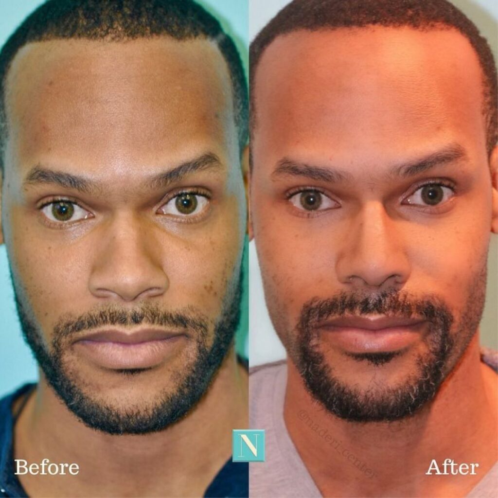 Before and after rhinoplasty of African American man showing subtle nose refinement while maintaining masculine features.