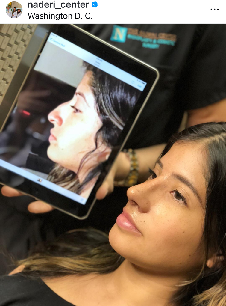 Latin Rhinoplasty real patient