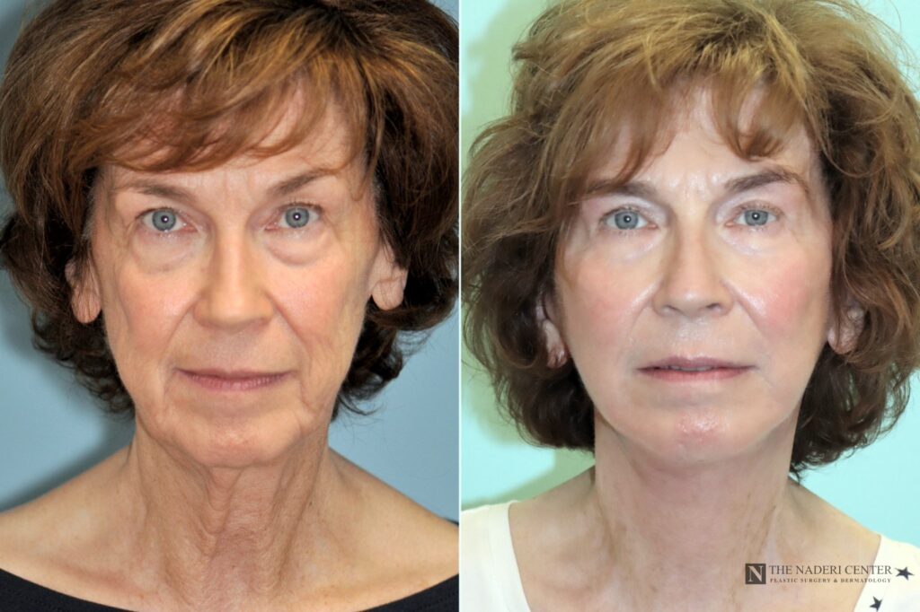 Before and after lower facelift and neck lift at The Naderi Center, front view