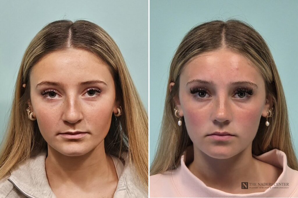 Before and after rhinoplasty by Dr. Shervin Naderi, front view