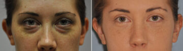 Blepharoplasty before and after at The Naderi Center, Reston, VA and Chevy Chase, MD, Patient 11983