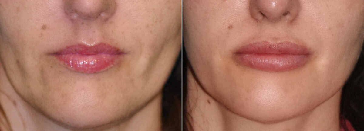 Patient 12555, Lip Implant Before and After Photos Before and after Lip Implant by Dr. Shervin Naderi, Patient 12555