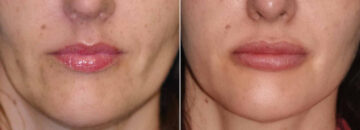 Before and after Lip Implant by Dr. Shervin Naderi, Patient 12555
