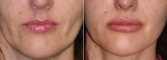 Before and after Lip Implant by Dr. Shervin Naderi, Patient 12555