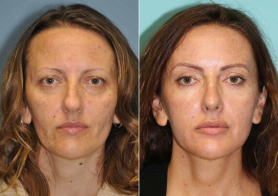 Before and after Light Therapy by Dr. Shervin Naderi, Patient 12589