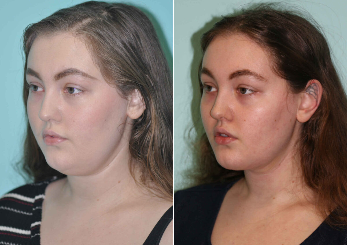 Patient 12726, Neck Liposuction Before and After Photos Before and after Neck Liposuction by Dr. Shervin Naderi, Patient 12726