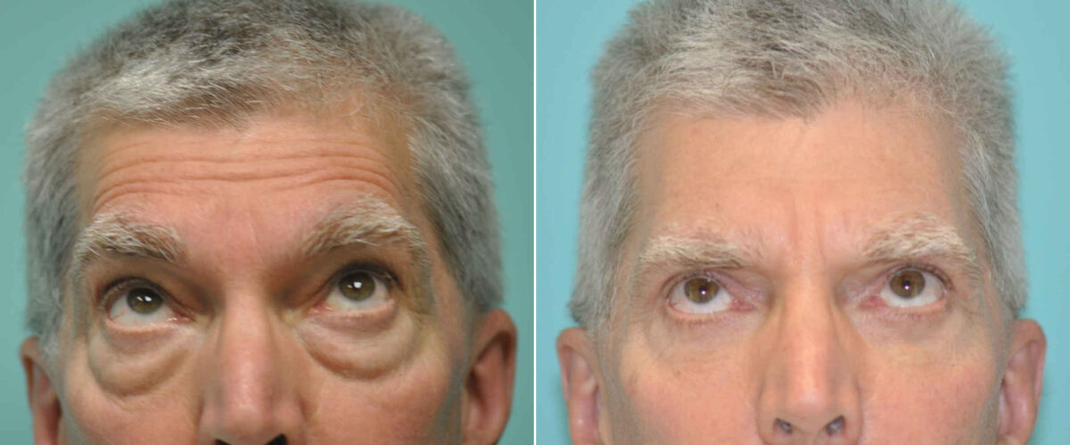 Patient 12767, Blepharoplasty Before and After Photos Before and after Blepharoplasty by Dr. Shervin Naderi, Patient 12767