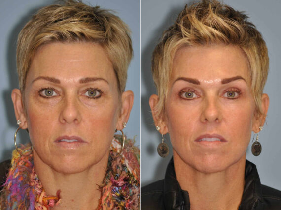 Before and after Light Therapy by Dr. Shervin Naderi, Patient 13012