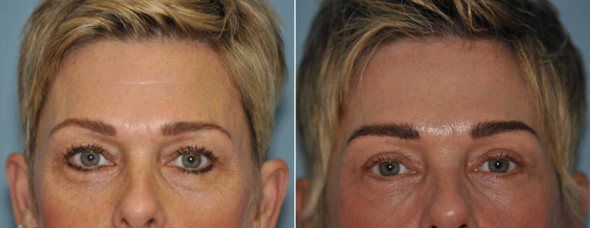 Before and after Blepharoplasty by Dr. Shervin Naderi, Patient 13041