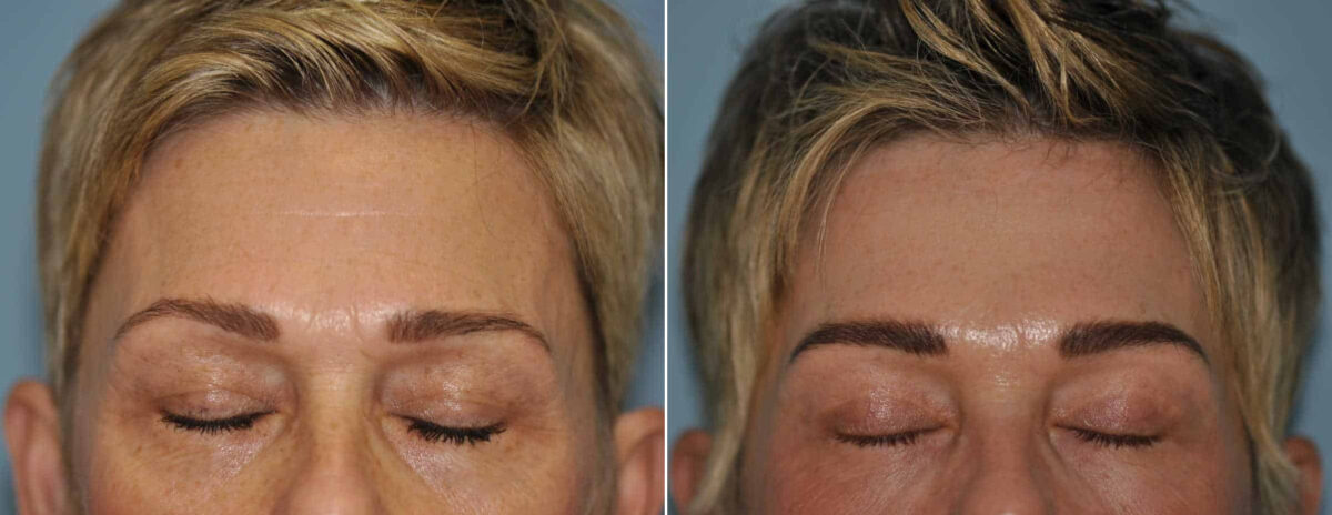 Before and after Blepharoplasty by Dr. Shervin Naderi, Patient 13041