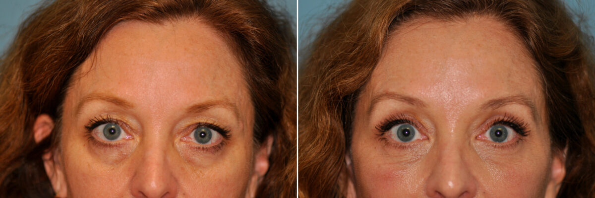 Patient 13294, Blepharoplasty Before and After Photos Before and after Blepharoplasty by Dr. Shervin Naderi, Patient 13294