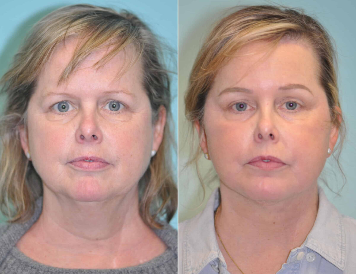 Patient 13875, Brow Lift Before and After Photos Before and after Brow Lift by Dr. Shervin Naderi, Patient 13875