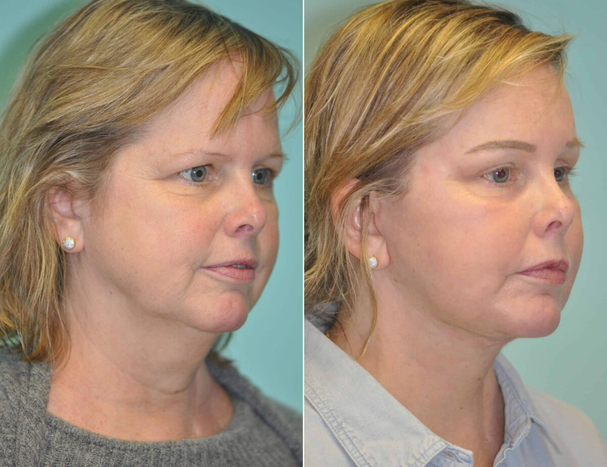 Patient 13875, Brow Lift Before and After Photos Before and after Brow Lift by Dr. Shervin Naderi, Patient 13875
