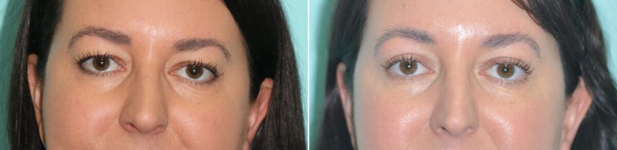Patient 14206, Blepharoplasty Before and After Photos Before and after Blepharoplasty by Dr. Shervin Naderi, Patient 14206
