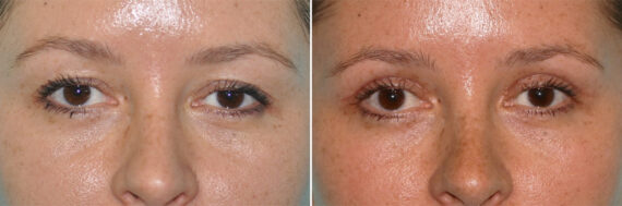 Before and after Blepharoplasty by Dr. Shervin Naderi, Patient 14278