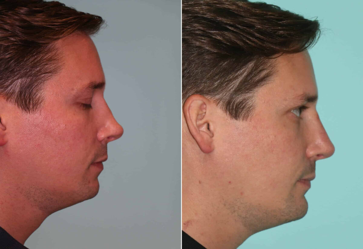 Patient 14491, Chin & Facial Implant Before and After Photos Before and after Chin & Facial Implant by Dr. Shervin Naderi, Patient 14491