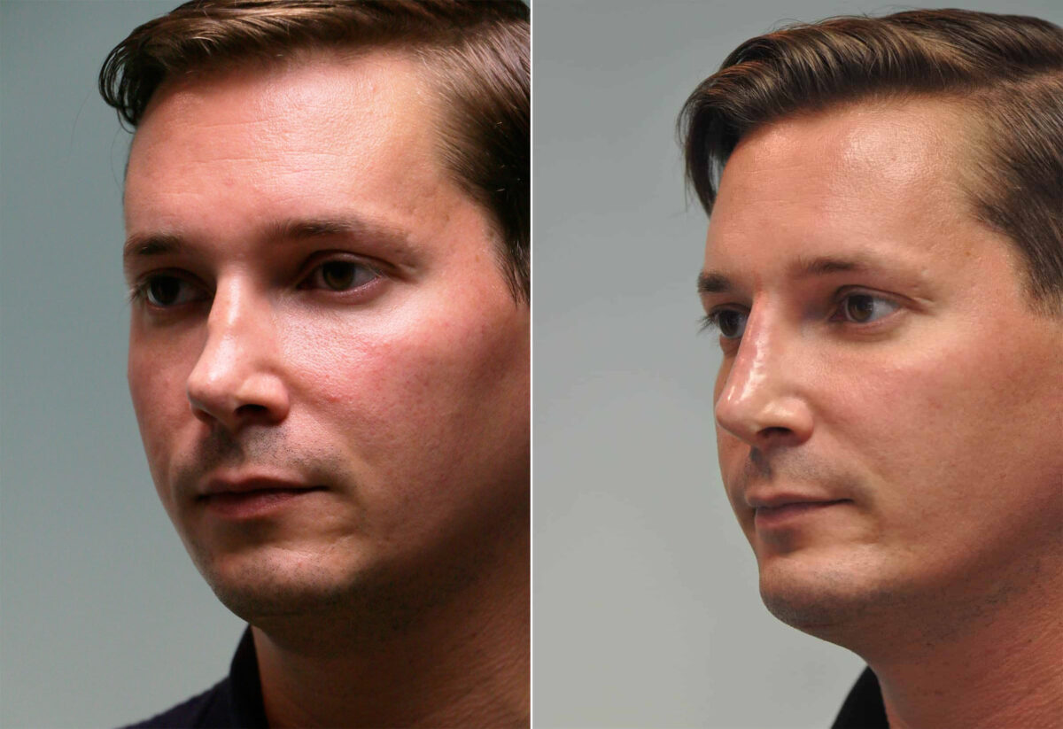 Patient 14491, Chin & Facial Implant Before and After Photos Before and after Chin & Facial Implant by Dr. Shervin Naderi, Patient 14491