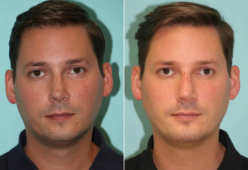 Before and after Chin & Facial Implant by Dr. Shervin Naderi, Patient 14491