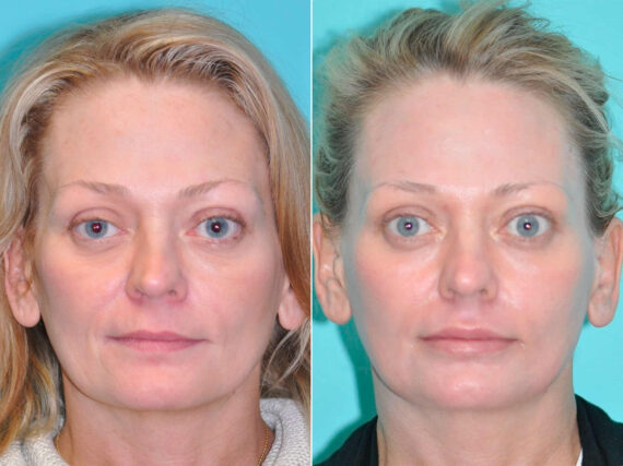 Before and after Light Therapy by Dr. Shervin Naderi, Patient 14527