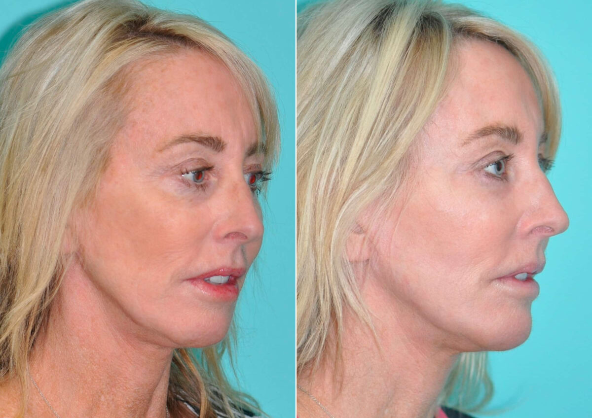 Patient 14568, Fat Transfer Before and After Photos Before and after Fat Transfer by Dr. Shervin Naderi, Patient 14568