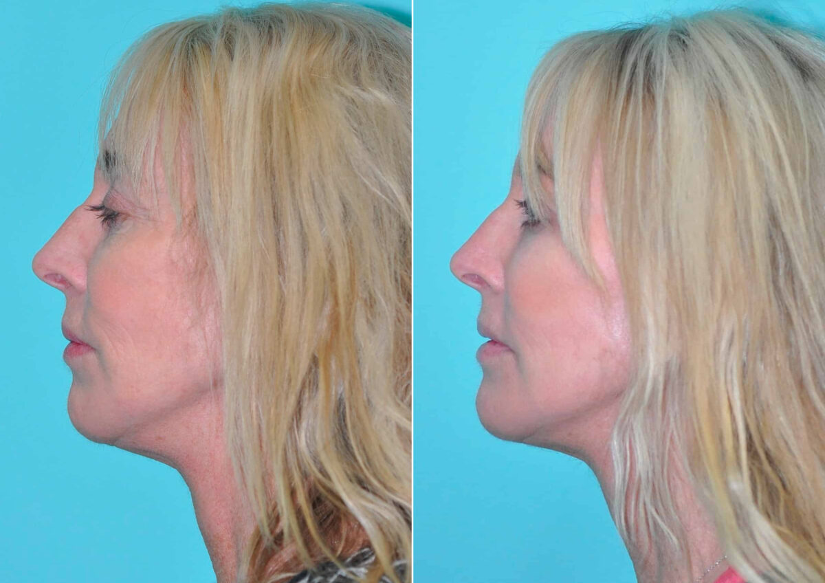 Patient 14568, Fat Transfer Before and After Photos Before and after Fat Transfer by Dr. Shervin Naderi, Patient 14568