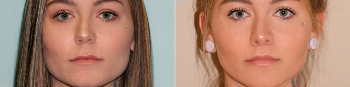 Patient 14578, Lip Lift Before and After Photos Before and after Lip Lift by Dr. Shervin Naderi, Patient 14578