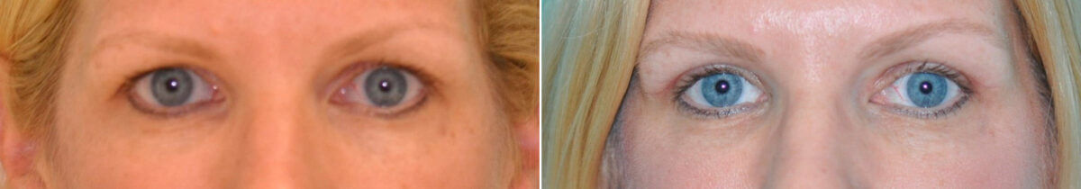 Patient 14609, Blepharoplasty Before and After Photos Before and after Blepharoplasty by Dr. Shervin Naderi, Patient 14609