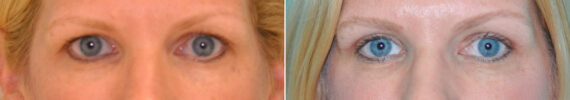 Before and after Blepharoplasty by Dr. Shervin Naderi, Patient 14609