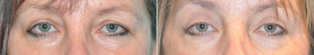 Patient 14644, Blepharoplasty Before and After Photos Before and after Blepharoplasty by Dr. Shervin Naderi, Patient 14644